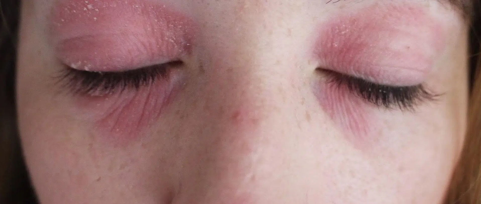 Eye Eczema Photo