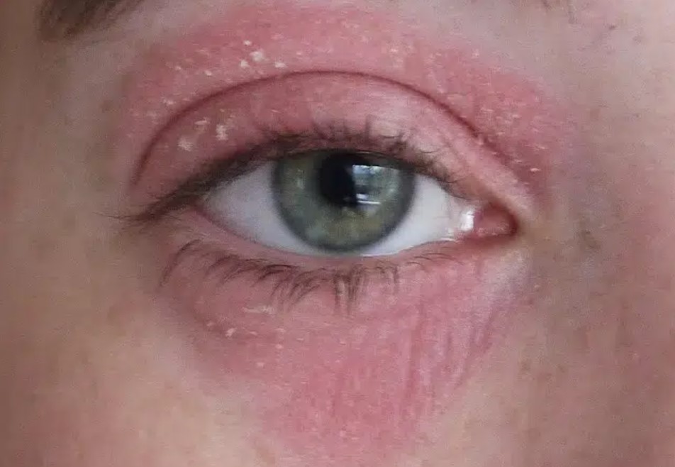 Eye Eczema - red and dry eyes