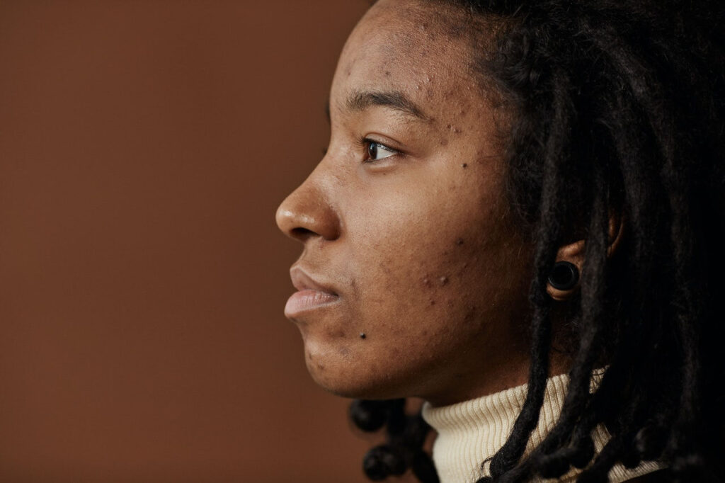 A young Black woman with her hair in braids stands side-on against a brown background. She has acne pimples and scarring on her cheeks.